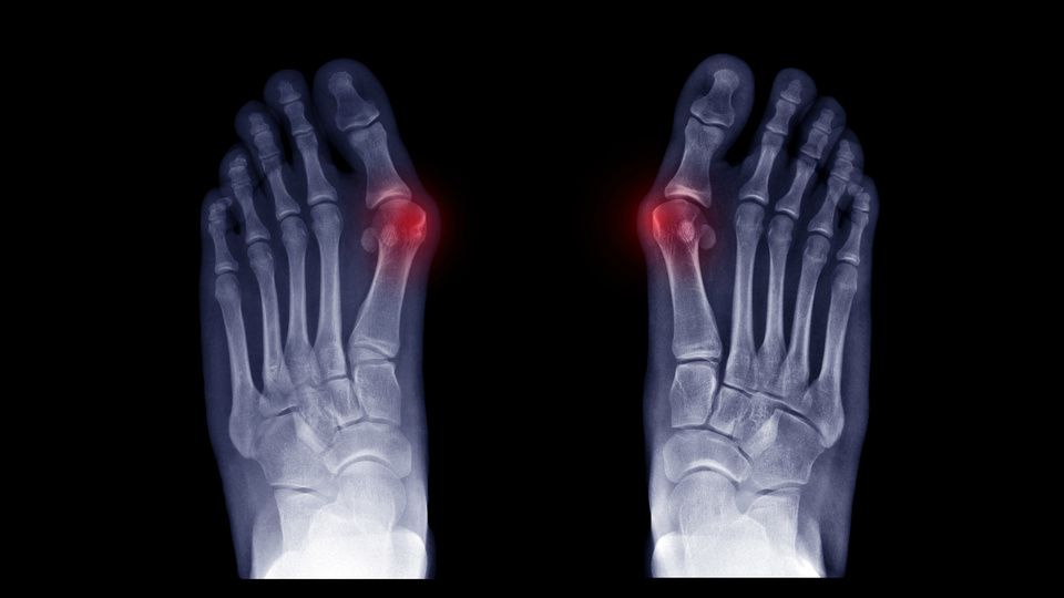 Five Reasons Your Big Toe Might Hurt