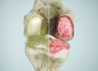 Top Types of Harmful Arthritis