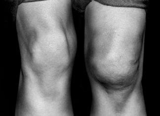 Are Your Joints Swollen?