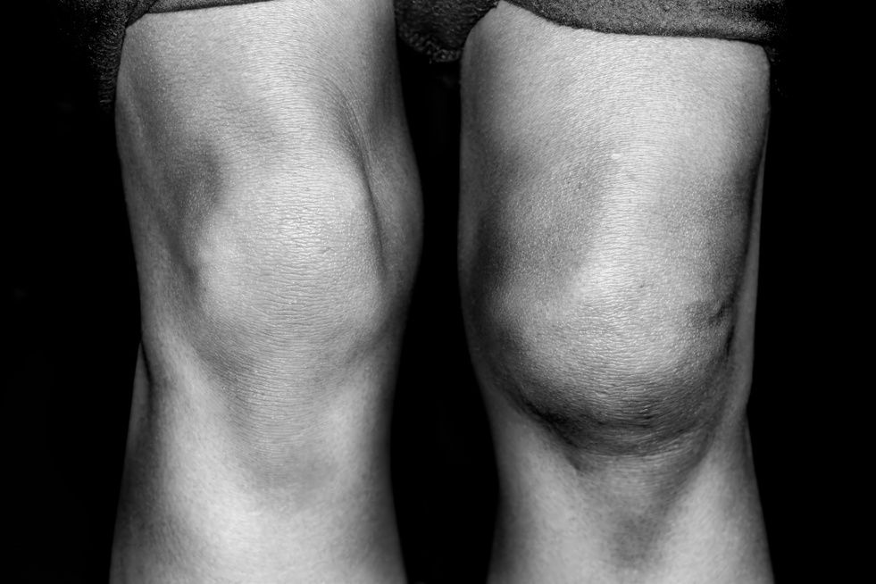 Are Your Joints Swollen?